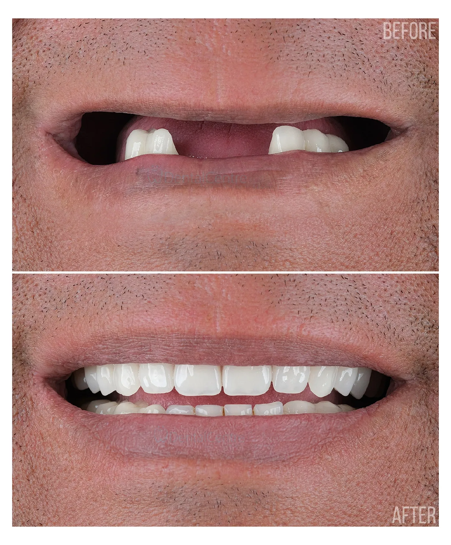 After Result